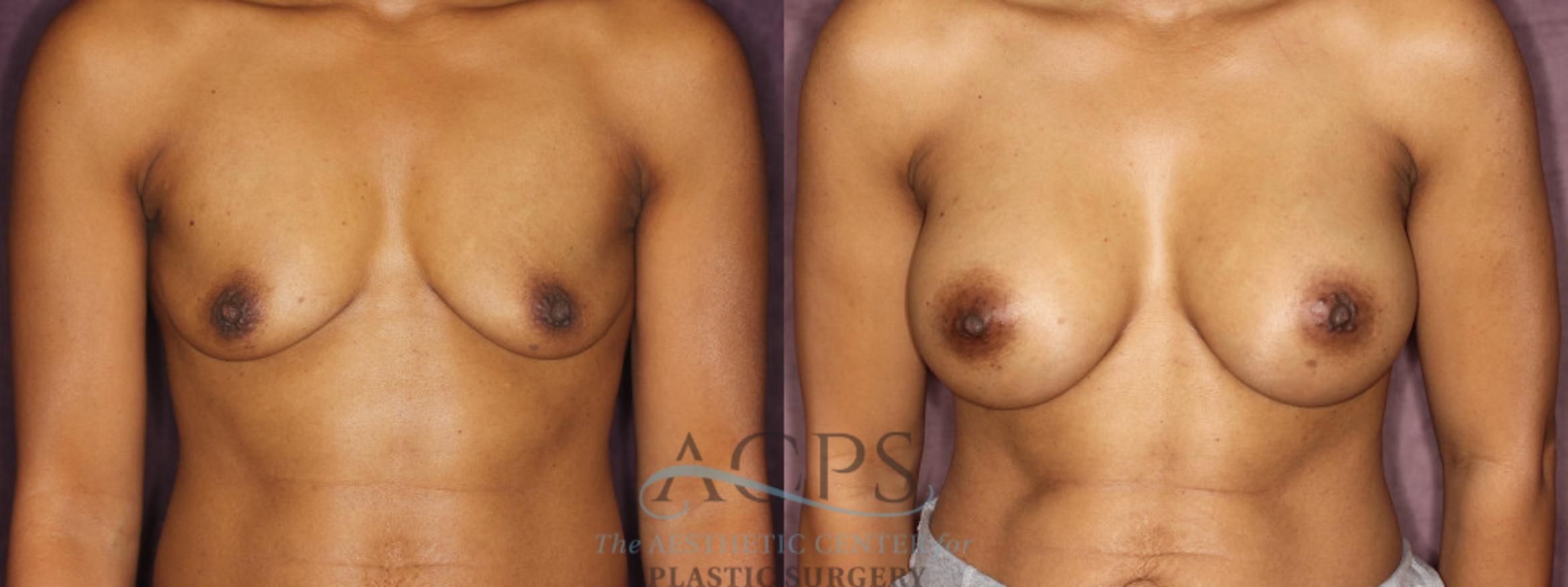 Before & After Breast Augmentation Case 837 Front View: View in Houston, TX