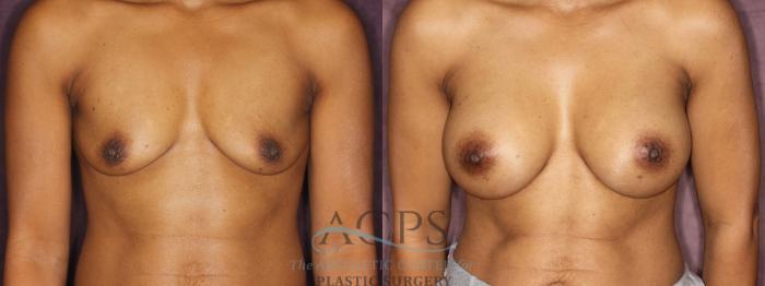 Before & After Breast Augmentation Case 837 Front View: View in Houston, TX