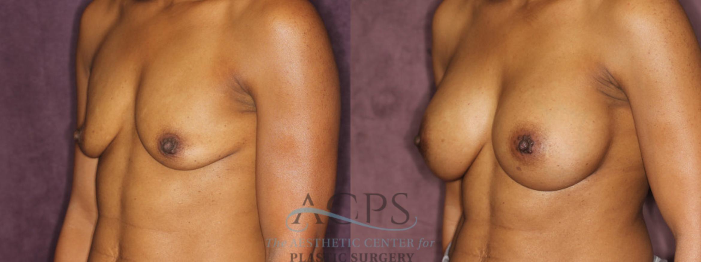 Before & After Breast Augmentation Case 837 Oblique Left View: View in Houston, TX