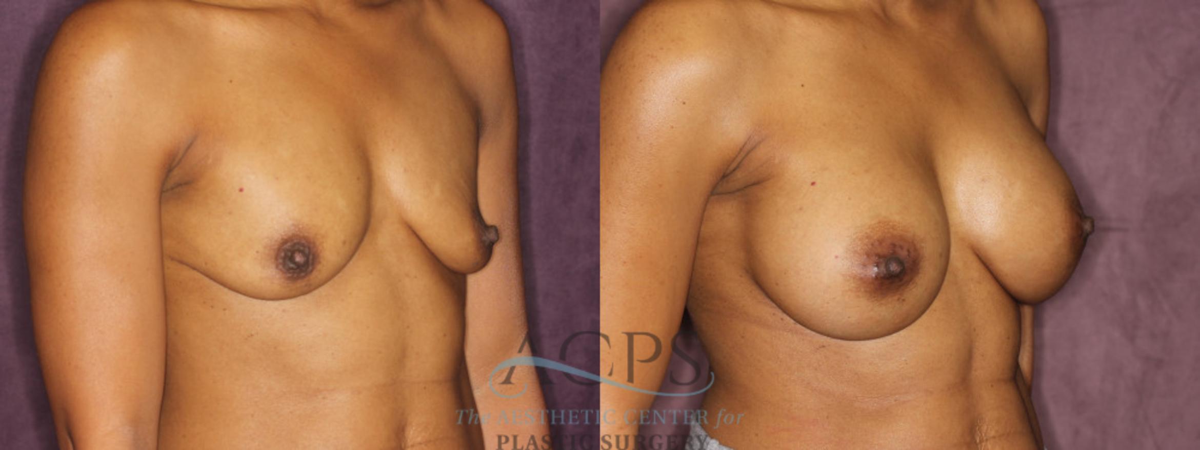 Before & After Breast Augmentation Case 837 Oblique Right View: View in Houston, TX