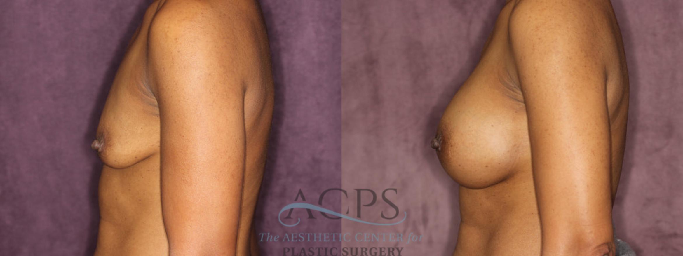 Before & After Breast Augmentation Case 837 Side Left View: View in Houston, TX
