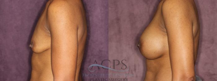 Before & After Breast Augmentation Case 837 Side Left View: View in Houston, TX