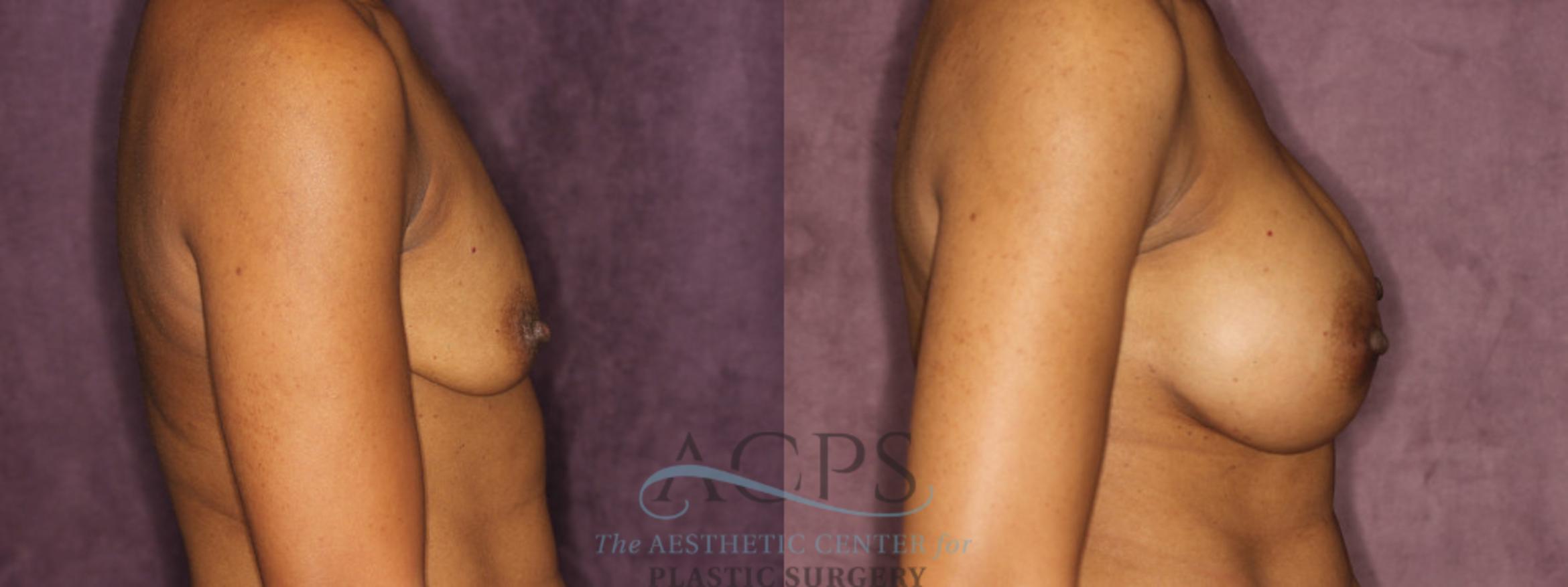 Before & After Breast Augmentation Case 837 Side Right View: View in Houston, TX