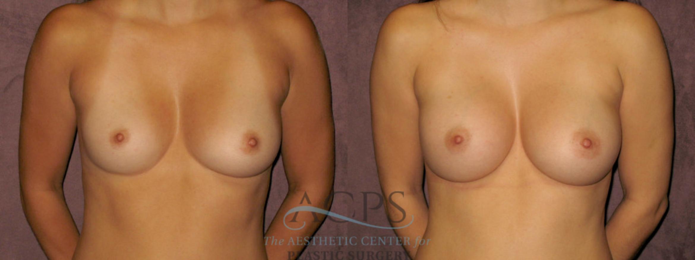 Before & After Breast Augmentation Case 838 Front View: View in Houston, TX