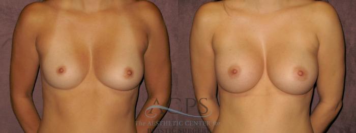 Before & After Breast Augmentation Case 838 Front View: View in Houston, TX