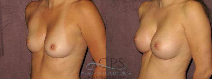 Before & After Breast Augmentation Case 838 Oblique Left View: View in Houston, TX