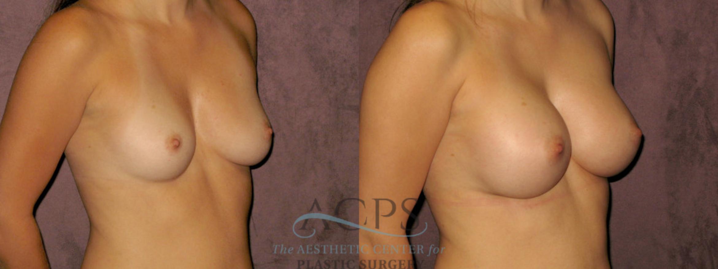 Before & After Breast Augmentation Case 838 Oblique Right View: View in Houston, TX
