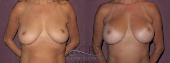 Before & After Breast Augmentation Case 839 Front View: View in Houston, TX