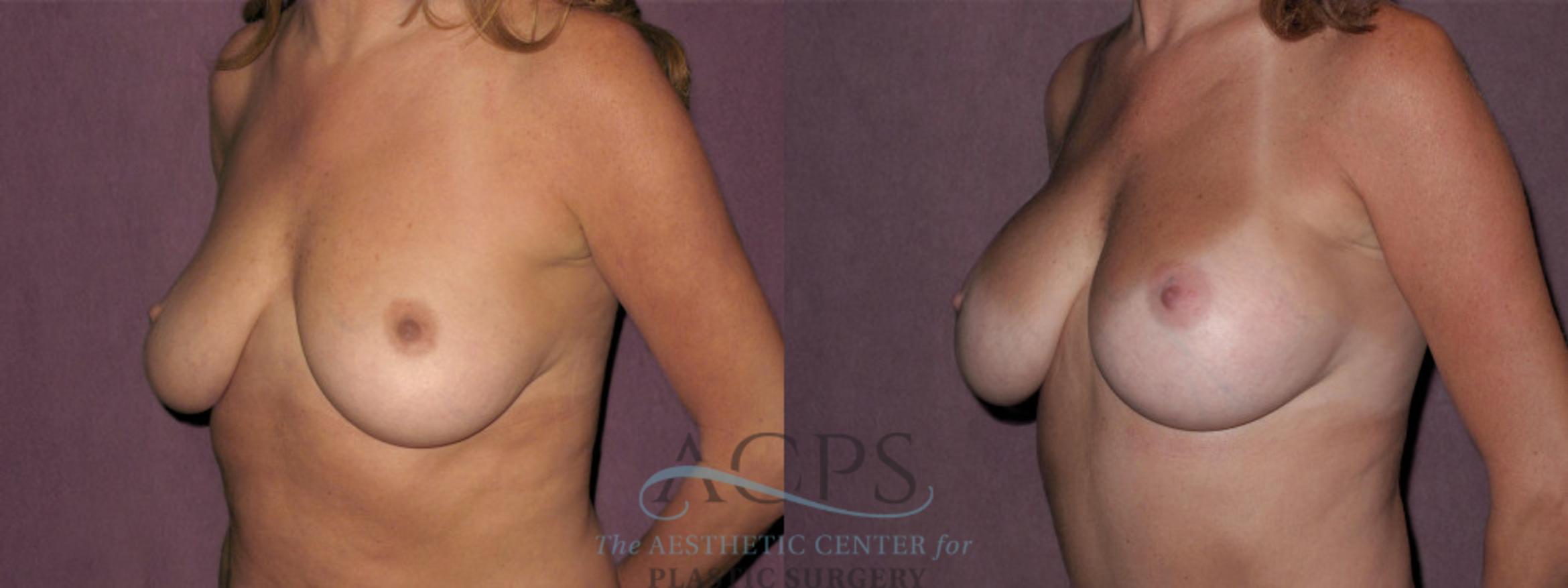 Before & After Breast Augmentation Case 839 Oblique Left View: View in Houston, TX