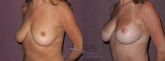 Before & After Breast Augmentation Case 839 Oblique Left View: View in Houston, TX