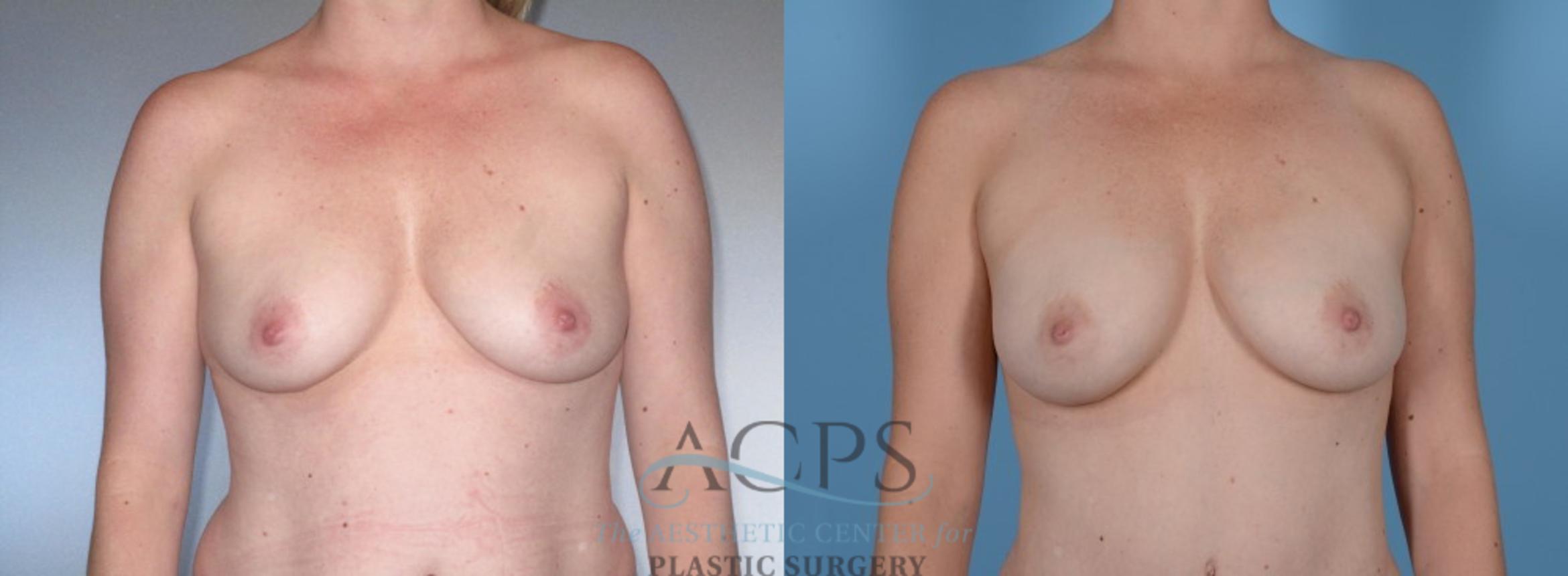 Before & After Breast Augmentation Case 840 Front View: View in Houston, TX