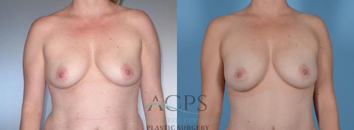Before & After Breast Augmentation Case 840 Front View: View in Houston, TX
