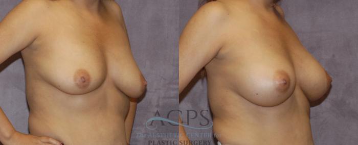 Before & After Breast Augmentation Case 843 Oblique View: View in Houston, TX