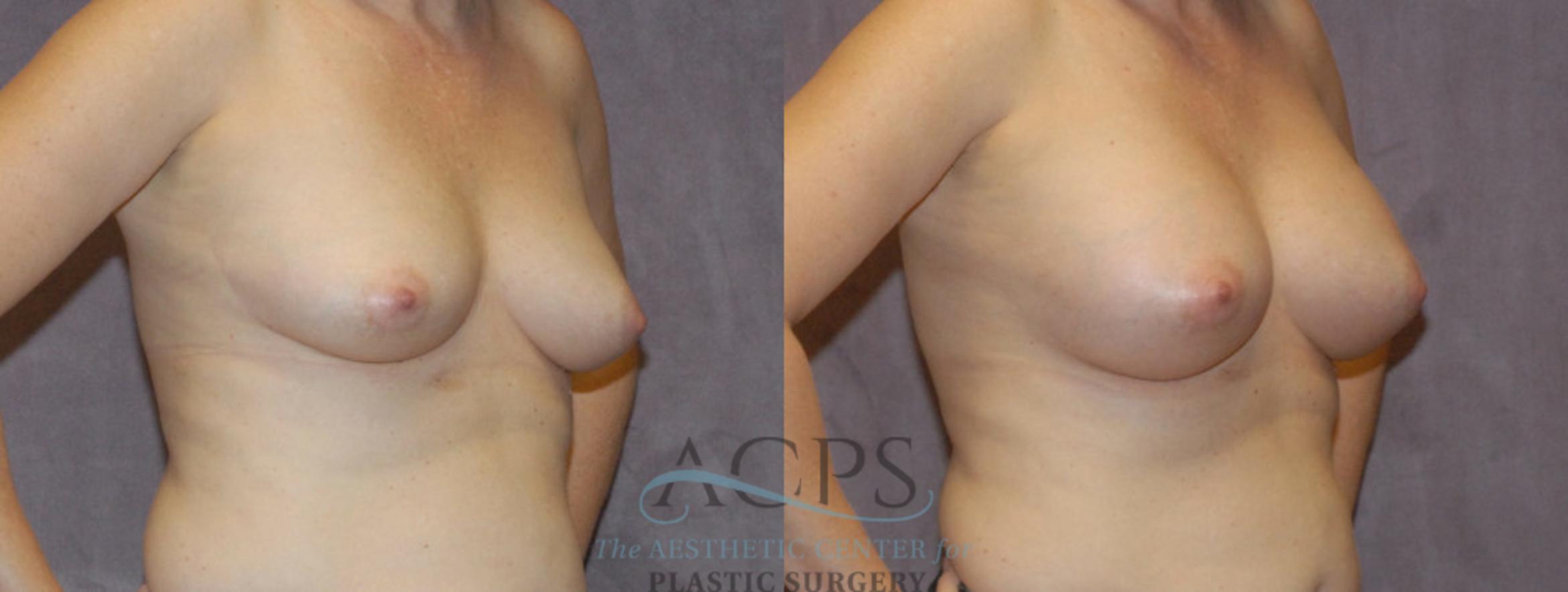 Before & After Breast Augmentation Case 844 Oblique View: View in Houston, TX
