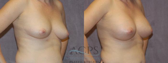 Before & After Breast Augmentation Case 844 Oblique View: View in Houston, TX