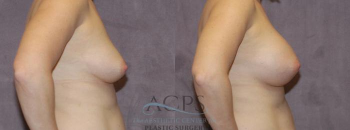 Before & After Breast Augmentation Case 844 Side View: View in Houston, TX