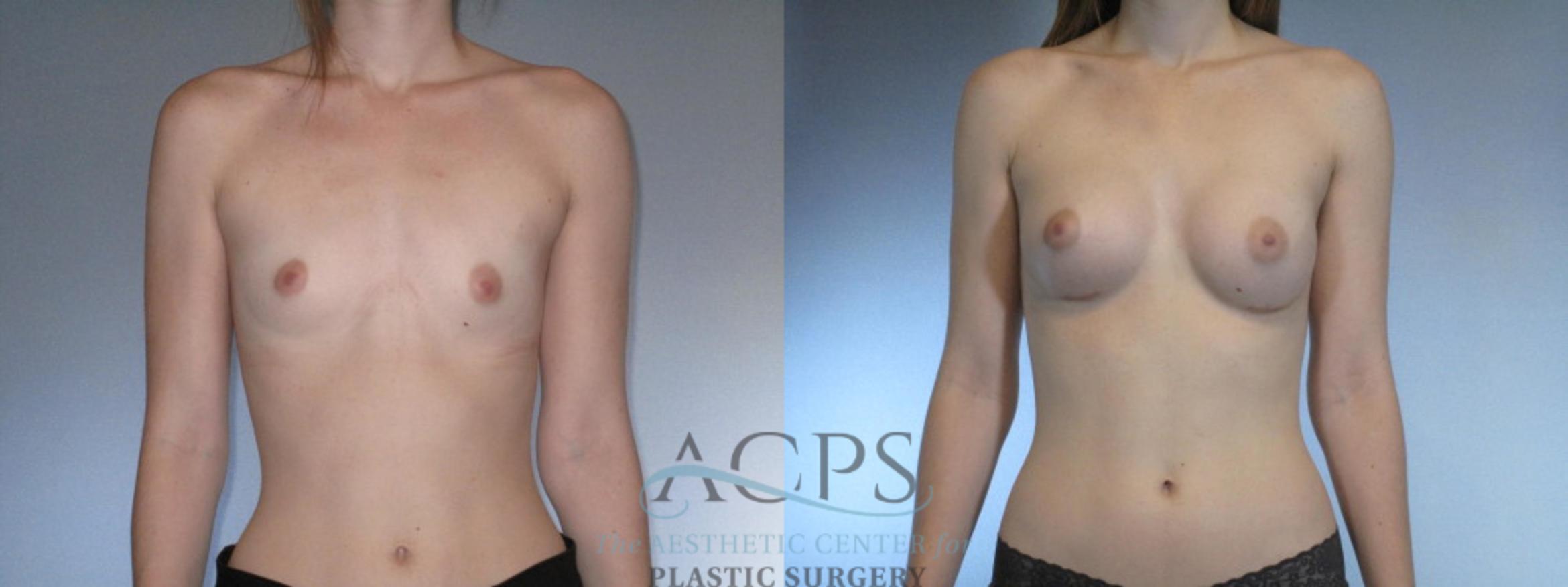 Before & After Breast Augmentation Case 845 Front View: View in Houston, TX