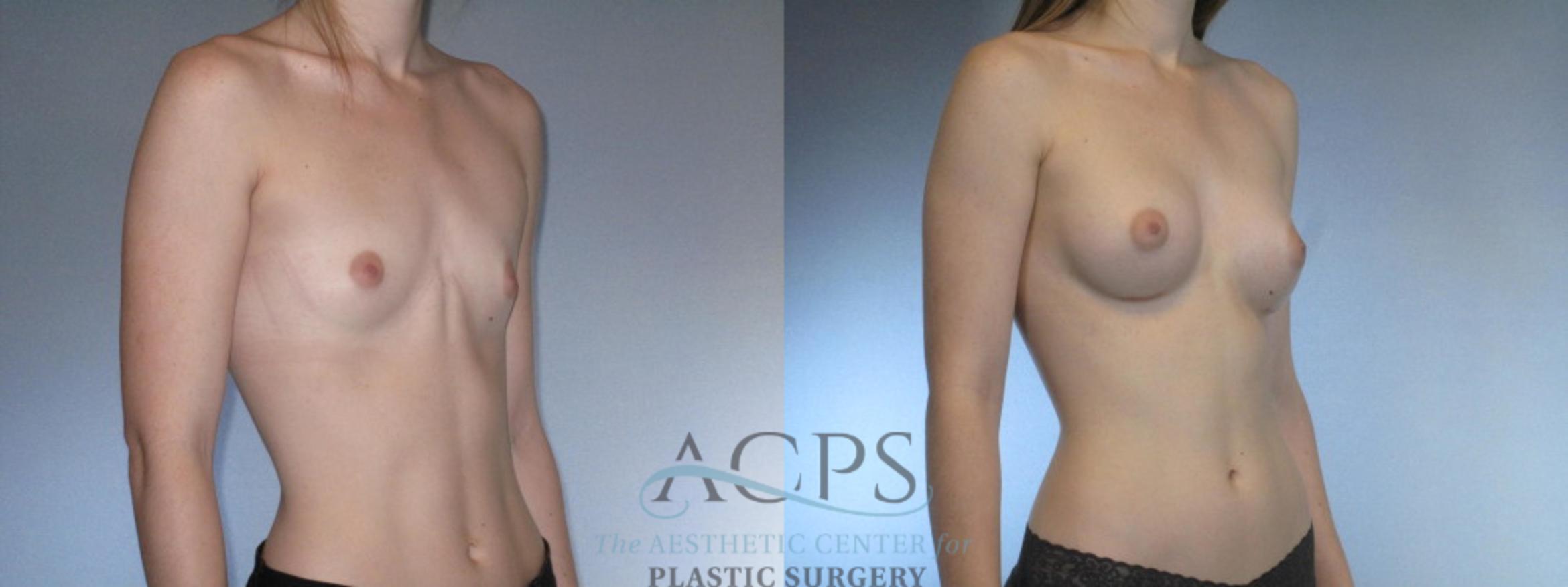 Before & After Breast Augmentation Case 845 Oblique View: View in Houston, TX