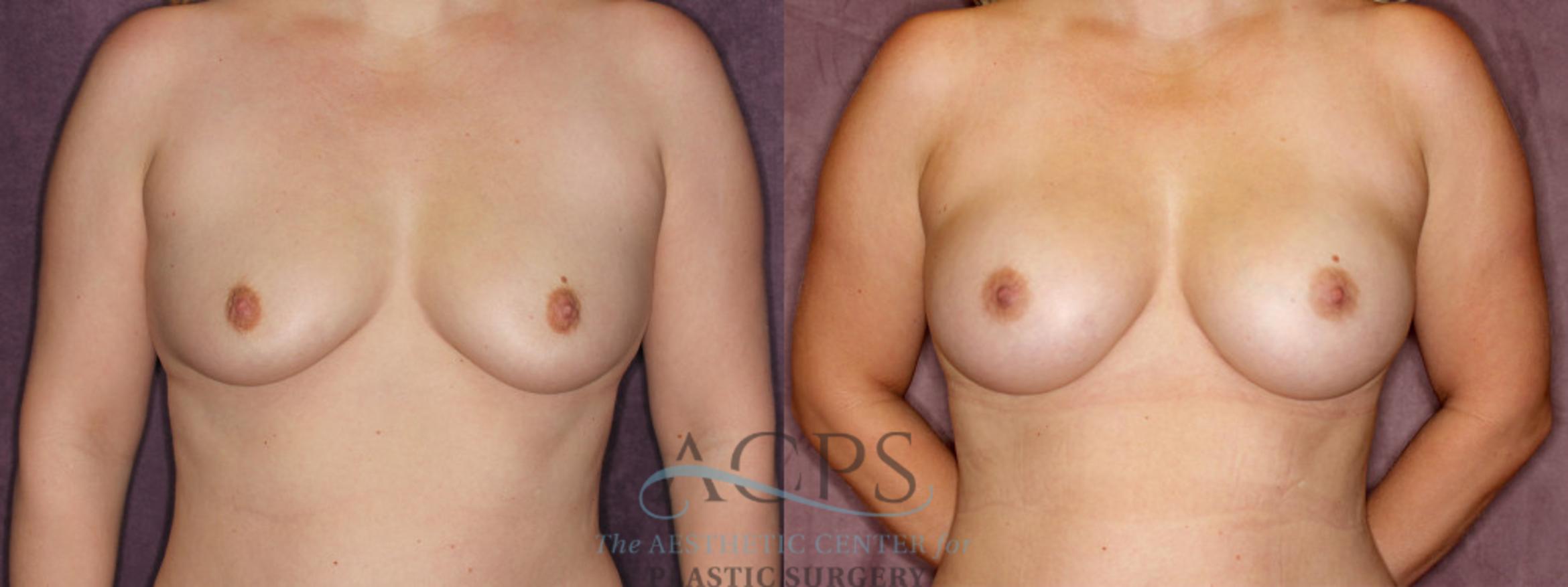 Before & After Breast Augmentation Case 847 Front View: View in Houston, TX