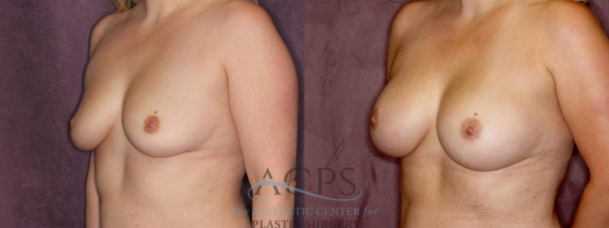 Before & After Breast Augmentation Case 847 Oblique Left View: View in Houston, TX