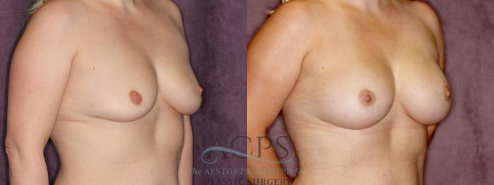 Before & After Breast Augmentation Case 847 Oblique Right View: View in Houston, TX