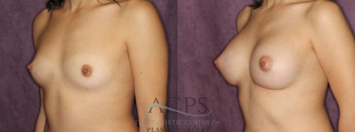 Before & After Breast Augmentation Case 848 Oblique Left View: View in Houston, TX