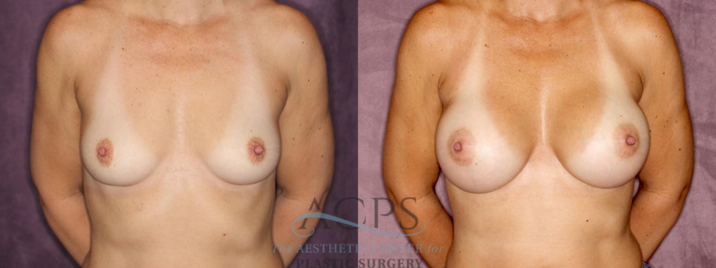 Before & After Breast Augmentation Case 849 Front View: View in Houston, TX
