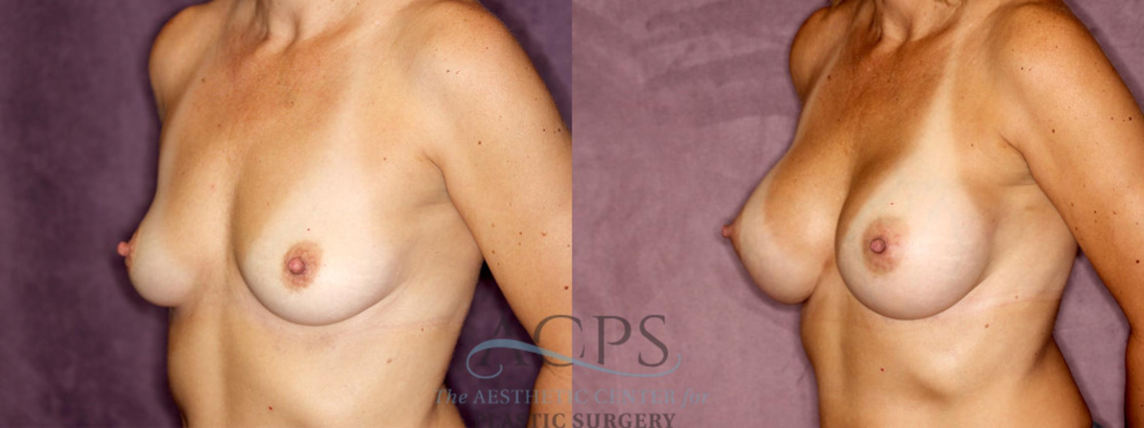 Before & After Breast Augmentation Case 849 Oblique Left View: View in Houston, TX