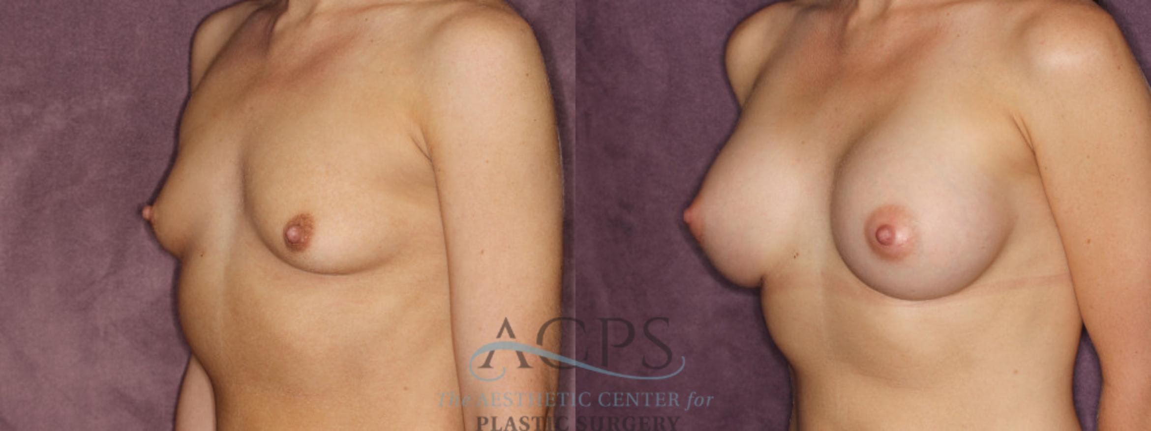 Before & After Breast Augmentation Case 850 Oblique Left View: View in Houston, TX