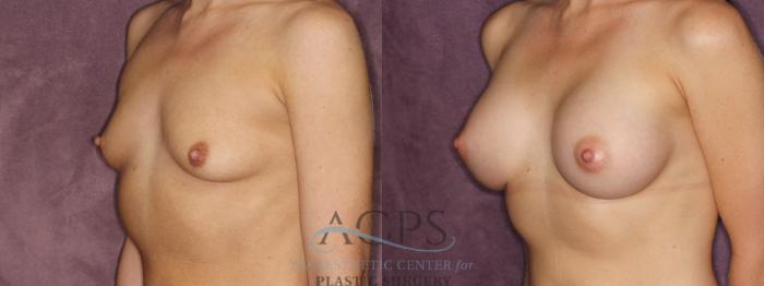 Before & After Breast Augmentation Case 850 Oblique Left View: View in Houston, TX