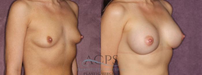 Before & After Breast Augmentation Case 850 Oblique Right View: View in Houston, TX