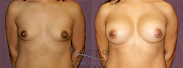 Before & After Breast Augmentation Case 851 Front View: View in Houston, TX
