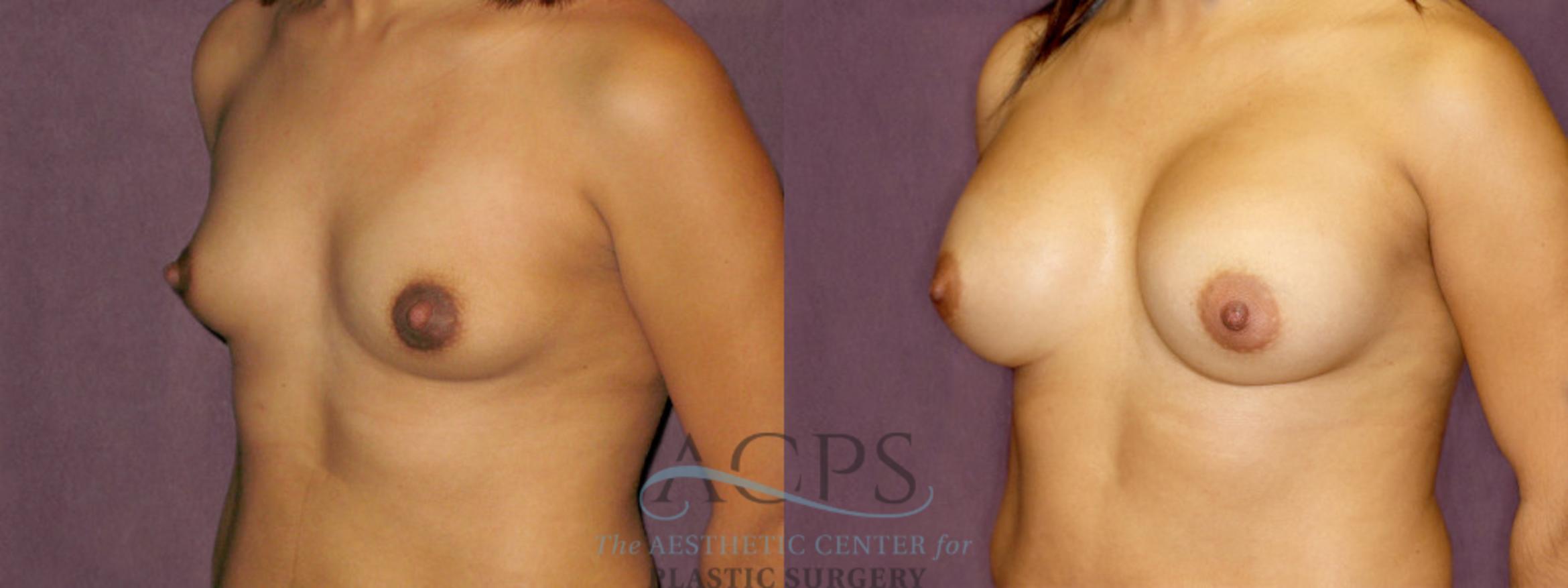 Before & After Breast Augmentation Case 851 Oblique Left View: View in Houston, TX