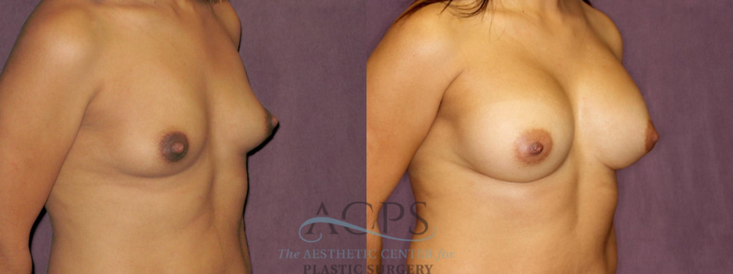 Before & After Breast Augmentation Case 851 Oblique Right View: View in Houston, TX