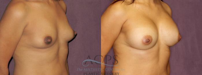 Before & After Breast Augmentation Case 851 Oblique Right View: View in Houston, TX