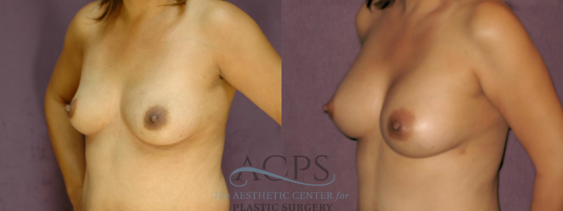 Before & After Breast Augmentation Case 852 Oblique Left View: View in Houston, TX