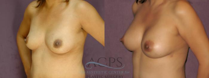 Before & After Breast Augmentation Case 852 Oblique Left View: View in Houston, TX