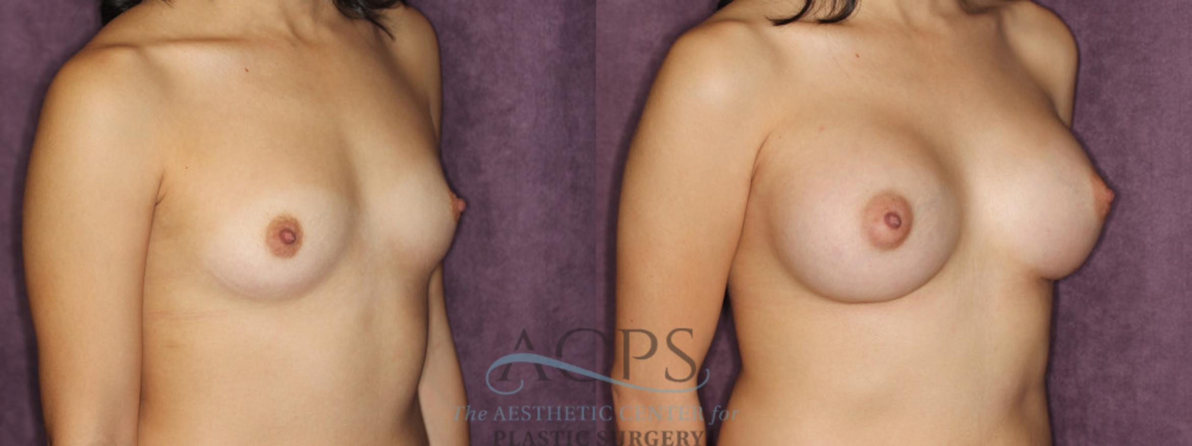 Before & After Breast Augmentation Case 853 Oblique Right View: View in Houston, TX