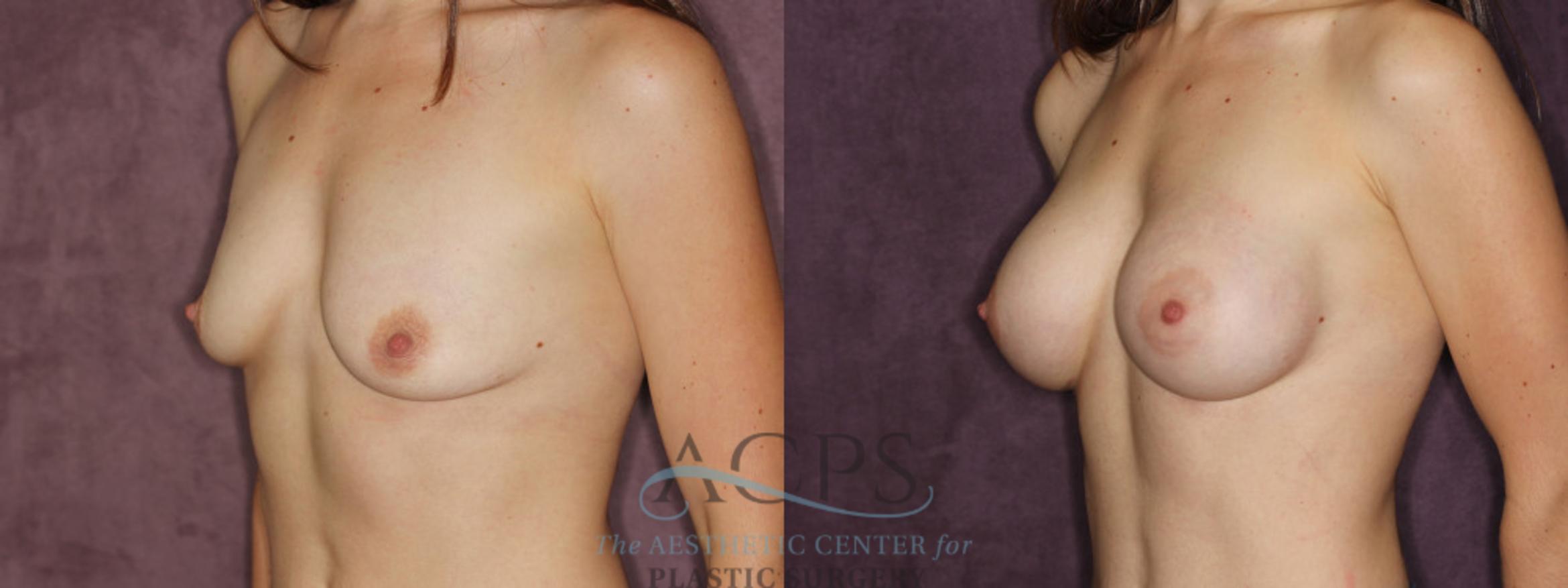 Before & After Breast Augmentation Case 854 Oblique Left View: View in Houston, TX