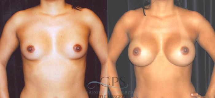 Before & After Breast Augmentation Case 857 Front View: View in Houston, TX