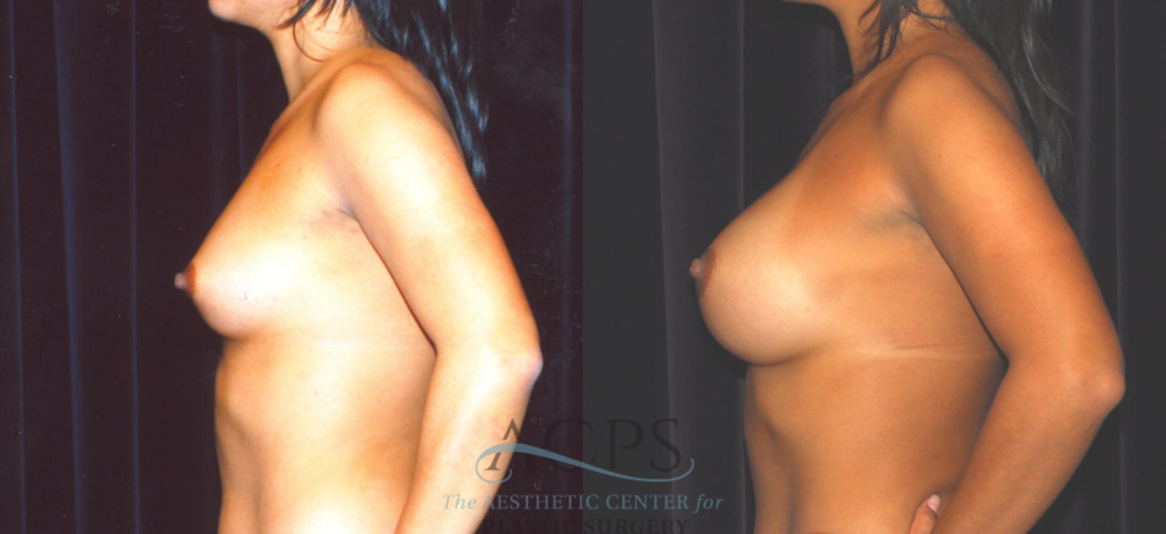 Before & After Breast Augmentation Case 857 Side View: View in Houston, TX