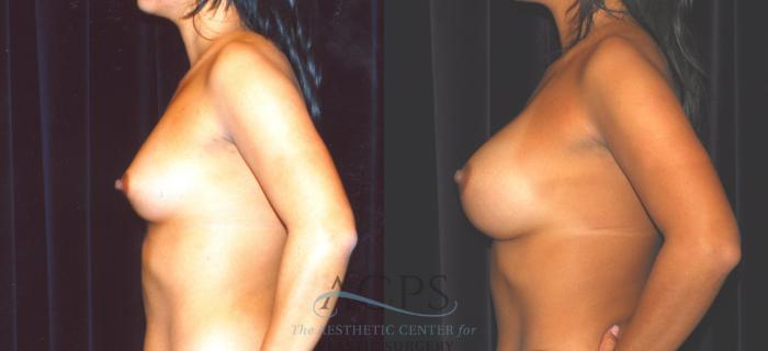 Before & After Breast Augmentation Case 857 Side View: View in Houston, TX
