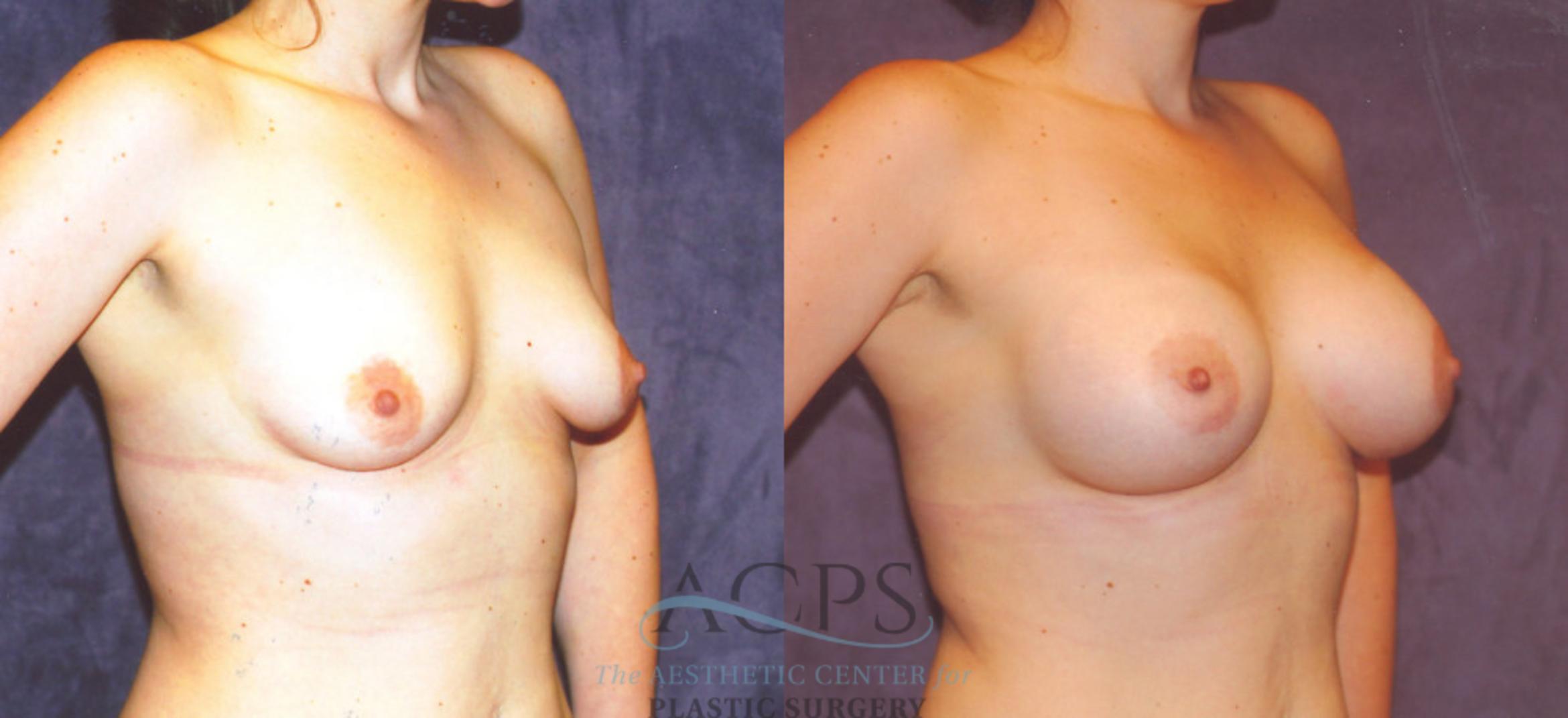 Before & After Breast Augmentation Case 858 Oblique View: View in Houston, TX