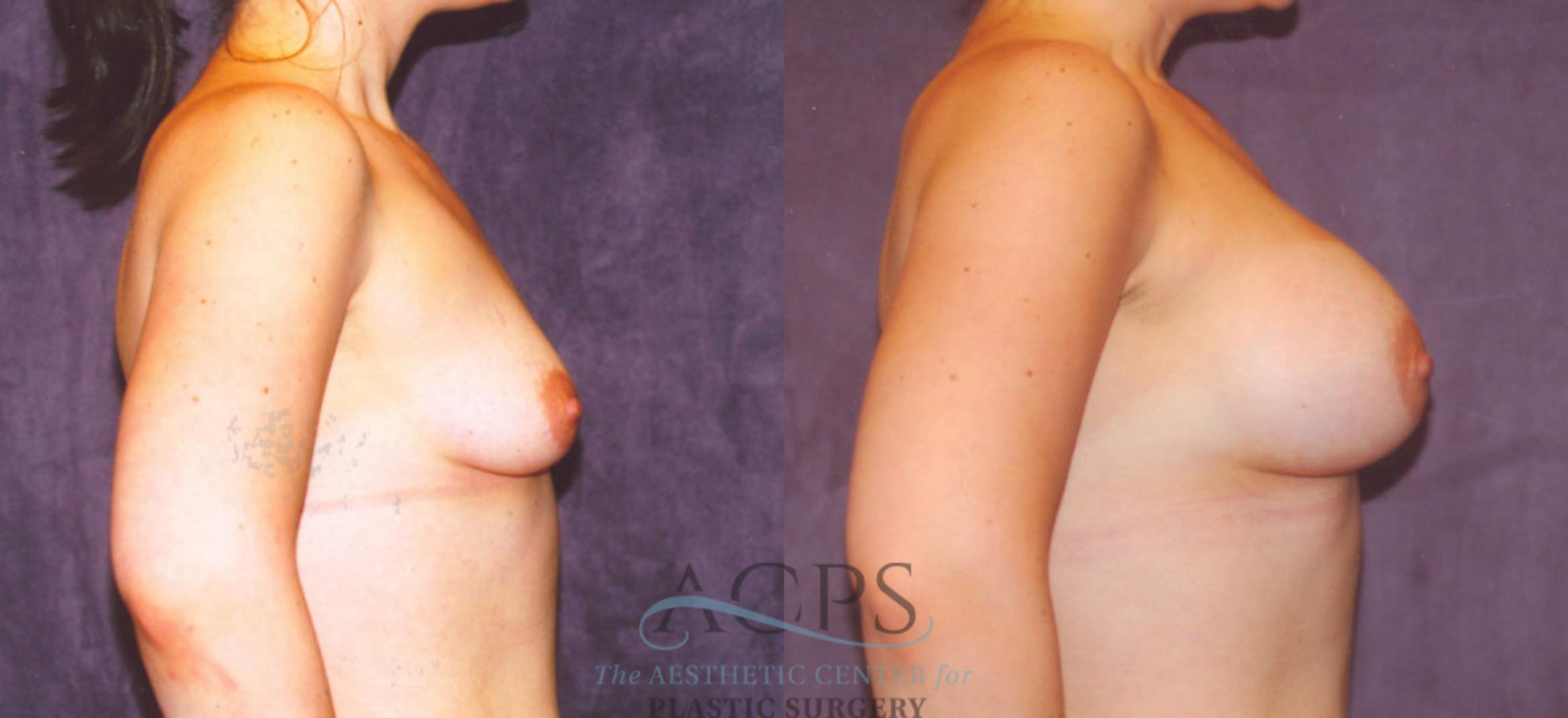 Before & After Breast Augmentation Case 858 Side View: View in Houston, TX