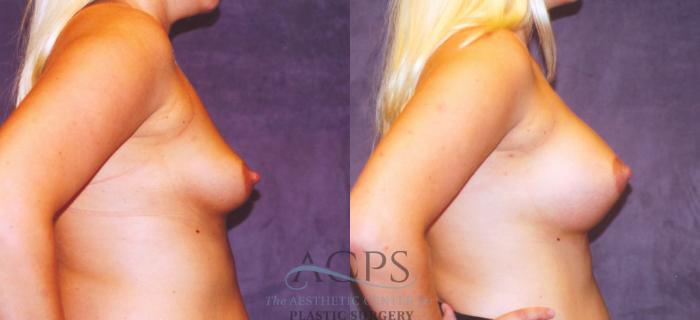 Before & After Breast Augmentation Case 860 Side View: View in Houston, TX