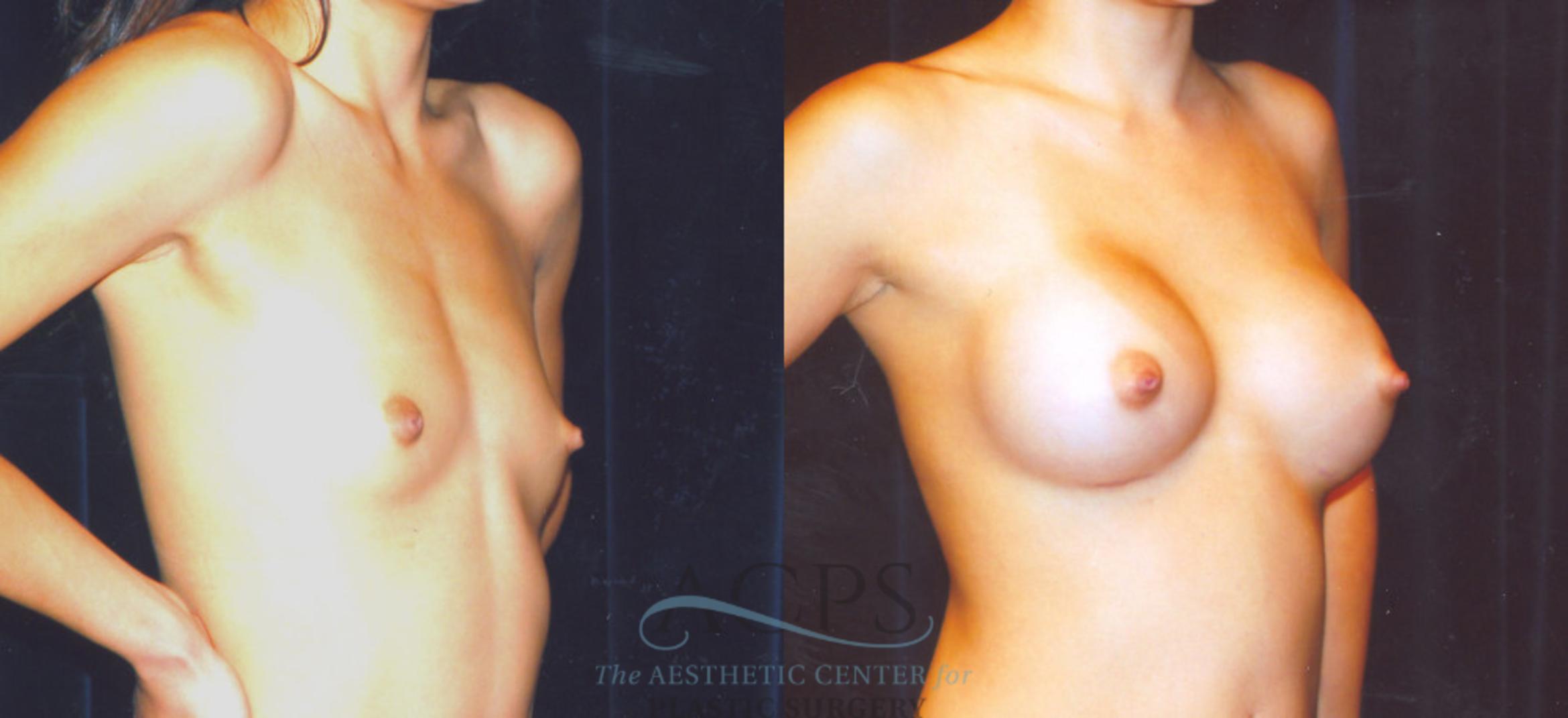Before & After Breast Augmentation Case 861 Oblique View: View in Houston, TX