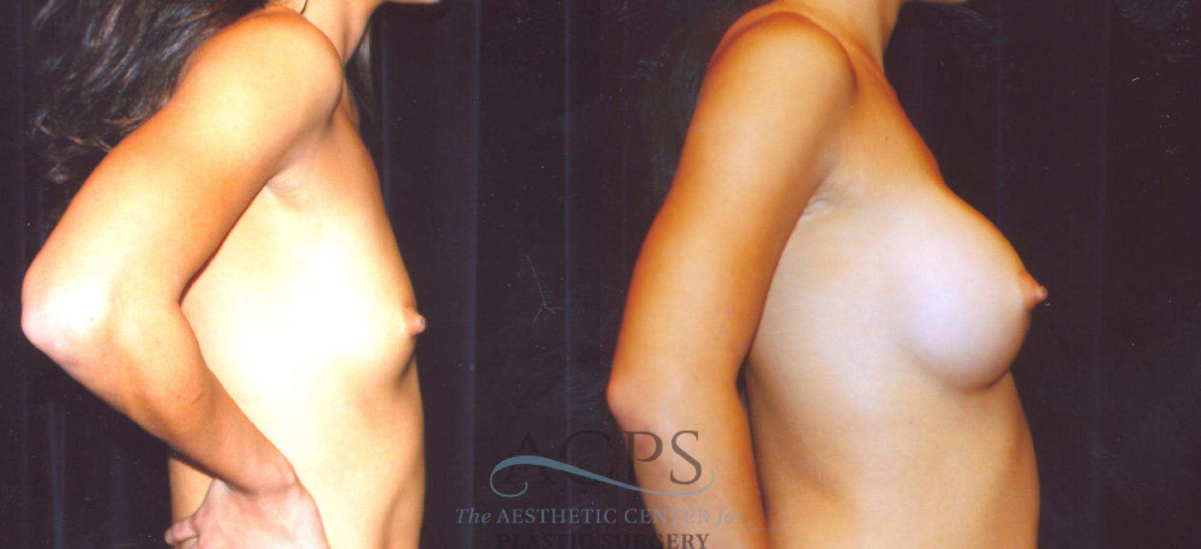 Before & After Breast Augmentation Case 861 Side View: View in Houston, TX