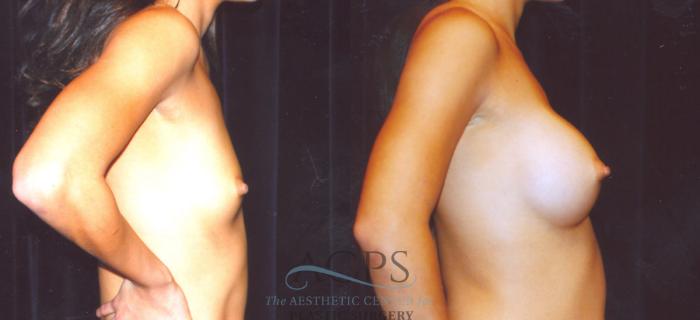 Before & After Breast Augmentation Case 861 Side View: View in Houston, TX
