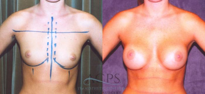 Before & After Breast Augmentation Case 862 Front View: View in Houston, TX