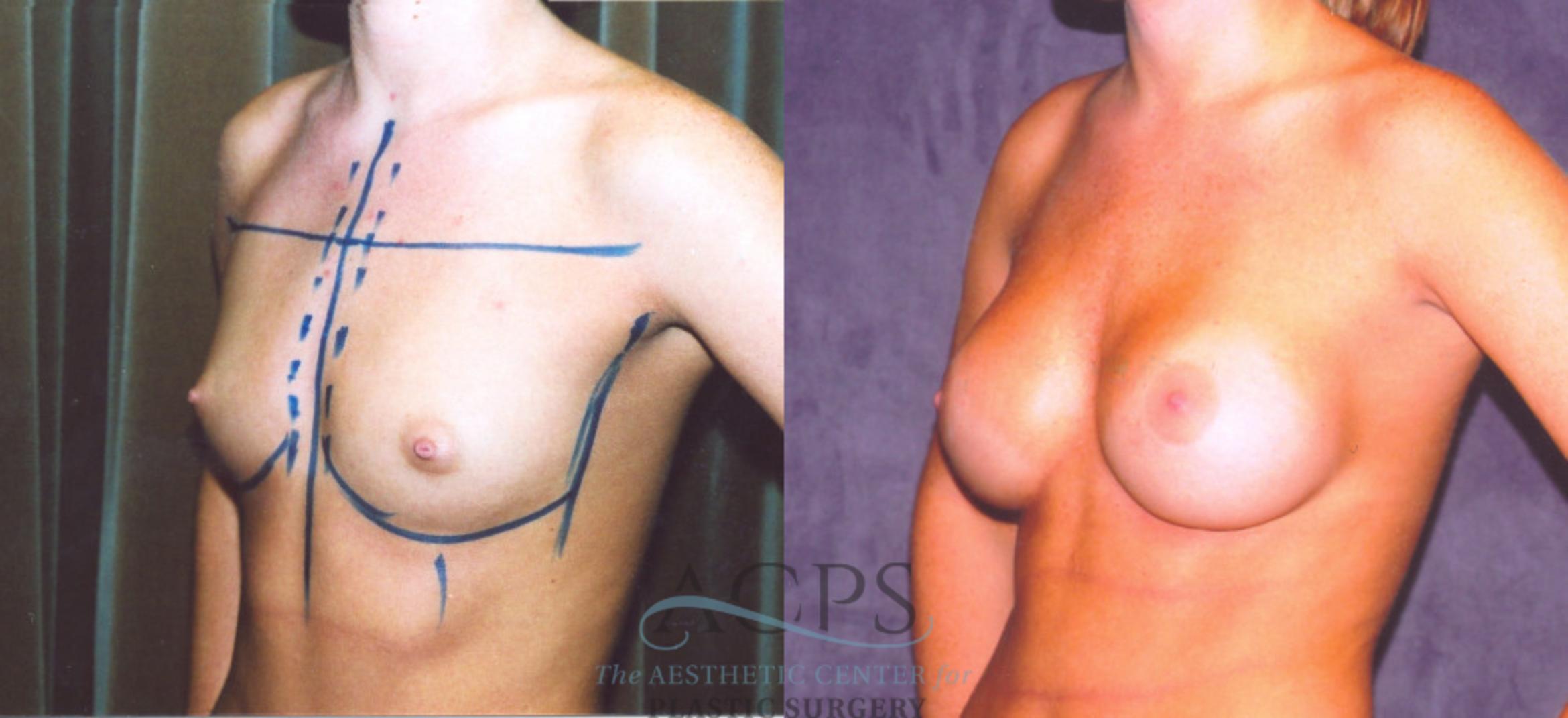 Before & After Breast Augmentation Case 862 Oblique View: View in Houston, TX